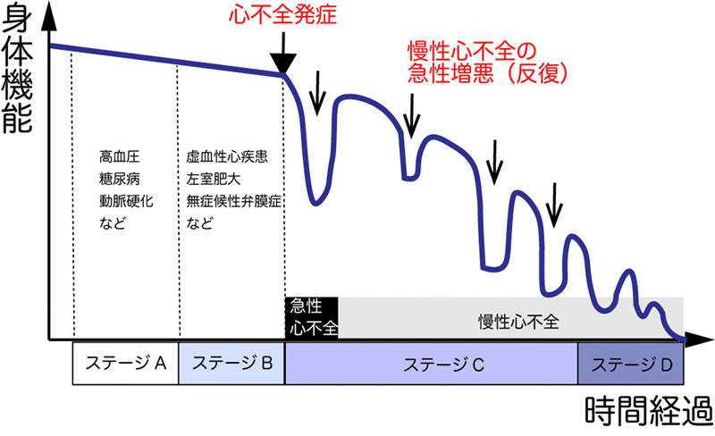 心不全は進行性の病気です
